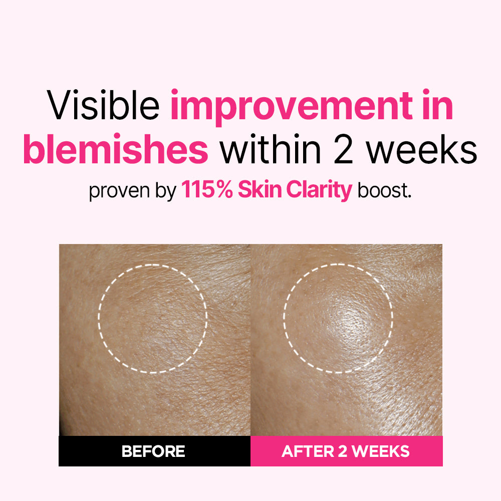 [Bestseller] Blemish Serum Triple Set