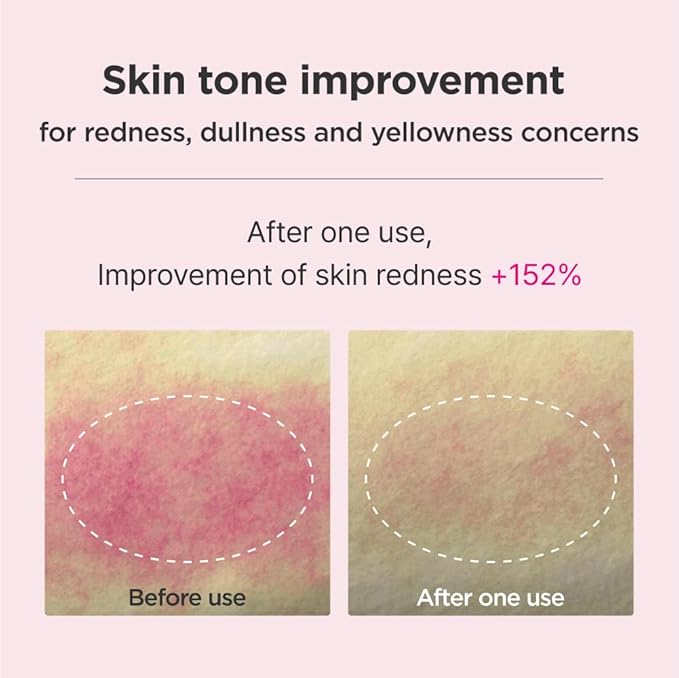 Blemish Care Up Serum Special Kit (Serum, Tonic Essence, Cream, Pad, Mask)